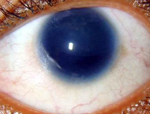 Aniridia: More Than a Missing Iris