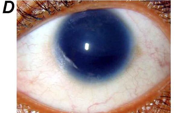Aniridia: More Than a Missing Iris