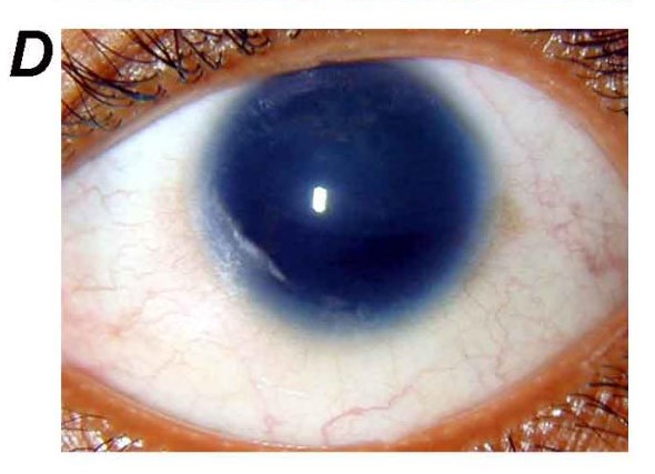 Aniridia - complete absence of iris tissue Aniridia: a uniformly large, dark pupillary aperture with complete absence of visible iris tissue, sclera bordering directly onto the corneal limbus