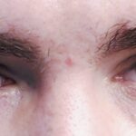 Anisocoria: clearly asymmetric pupil sizes between the two eyes, with one pupil noticeably larger than the other in the same ambient light