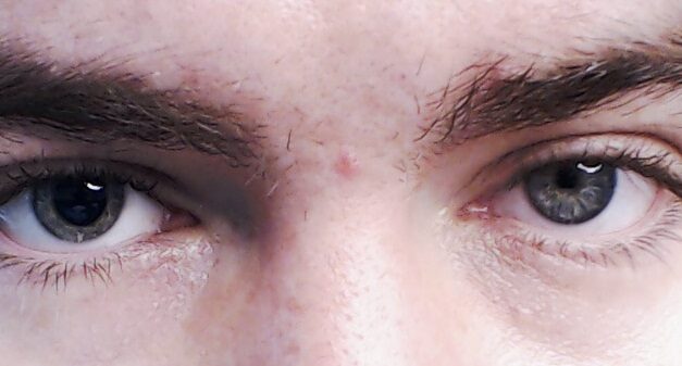 Anisocoria: Which Pupil Is the Abnormal One?