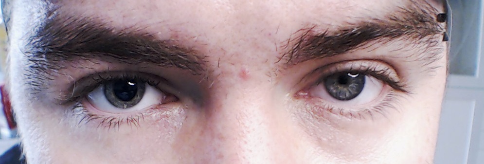 Anisocoria: Which Pupil Is the Abnormal One?