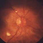 Proliferative diabetic retinopathy: a fine network of abnormal new vessels arising at the optic disc, the VEGF-driven neovascularisation targeted by anti-VEGF therapy