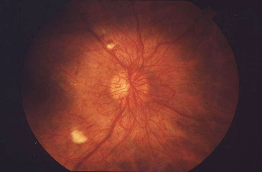 Proliferative diabetic retinopathy: a fine network of abnormal new vessels arising at the optic disc, the VEGF-driven neovascularisation targeted by anti-VEGF therapy