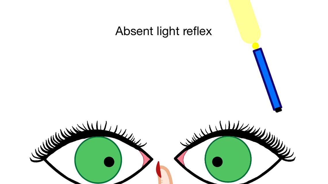 Argyll Robertson Pupil: The Sign That Still Points to Neurosyphilis