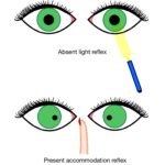 Argyll Robertson pupil: diagram illustrating light-near dissociation, with an absent pupillary light reflex but a preserved accommodation (near) reflex