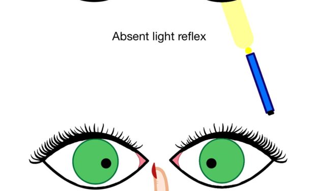Argyll Robertson Pupil: The Sign That Still Points to Neurosyphilis