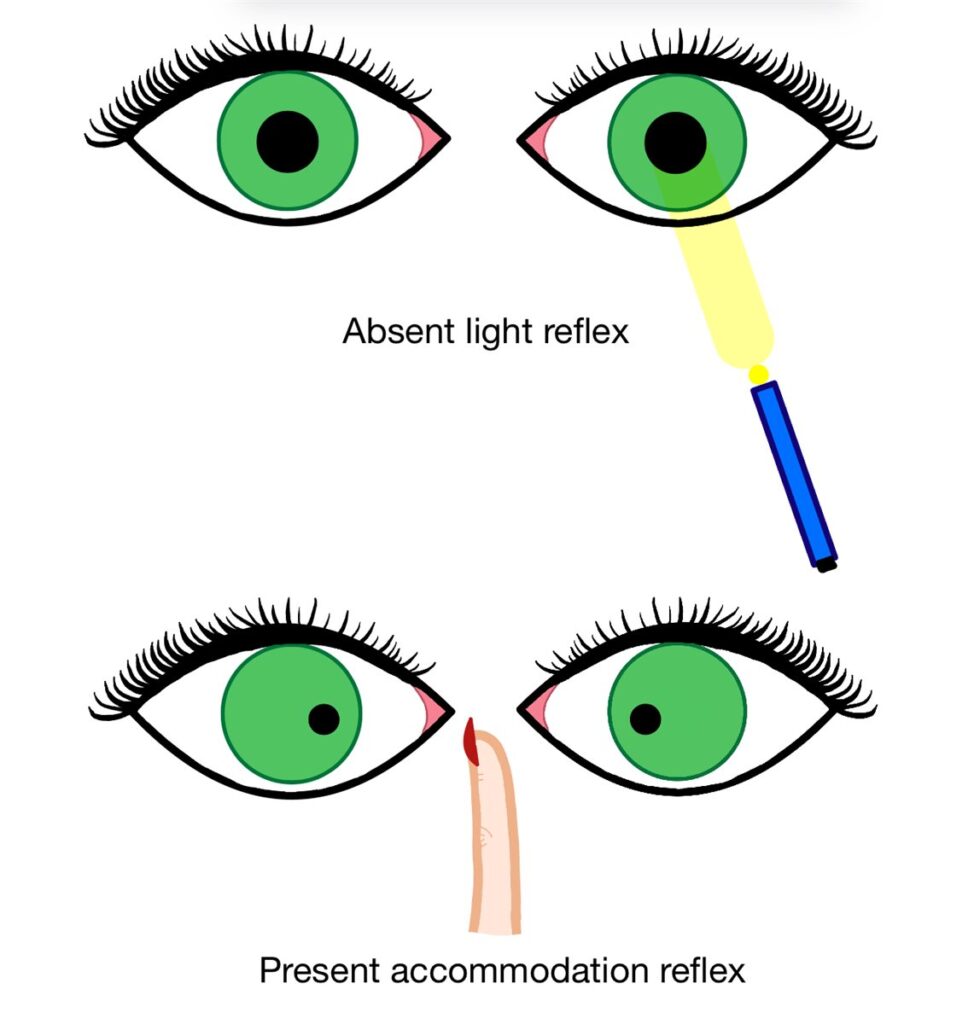 Argyll Robertson pupil: diagram illustrating light-near dissociation, with an absent pupillary light reflex but a preserved accommodation (near) reflex