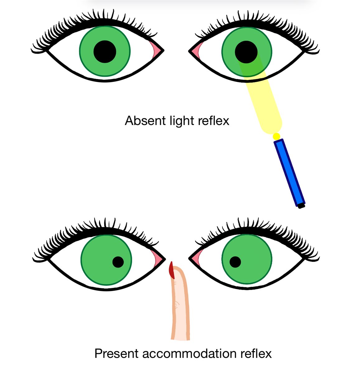 Argyll Robertson pupil: diagram illustrating light-near dissociation, with an absent pupillary light reflex but a preserved accommodation (near) reflex