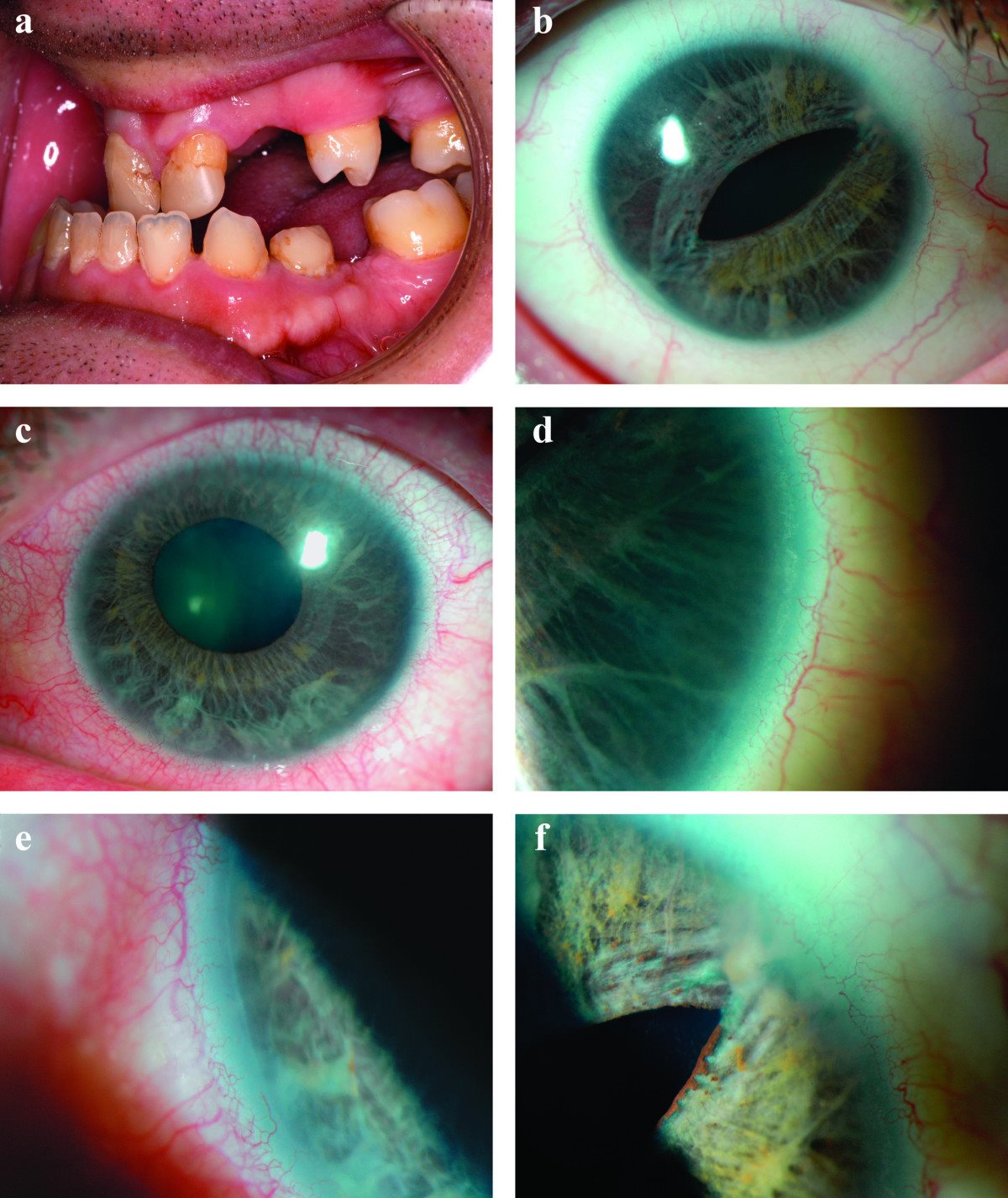 Axenfeld-Rieger syndrome: slit-lamp photographs showing slit pupil and iris atrophy, corectopia, posterior embryotoxon, and peripheral anterior synechiae across affected eyes, alongside dental anomalies