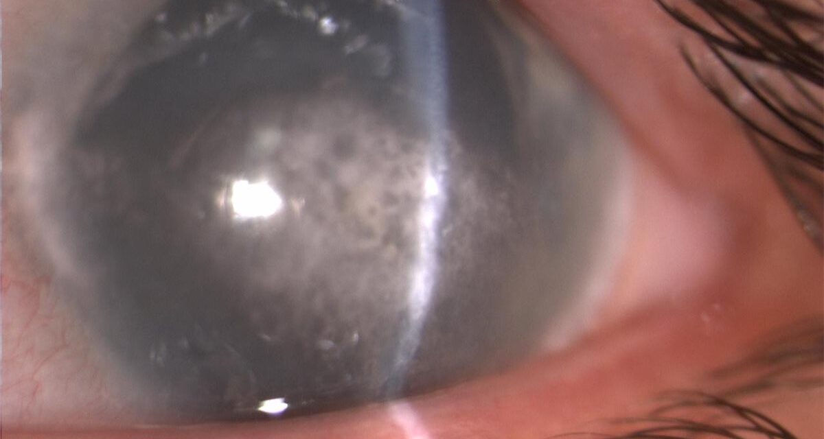 Band Keratopathy: When Calcium Clouds the Cornea