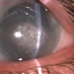 Band keratopathy: horizontal, gray-white calcific band crossing the central cornea within the interpalpebral zone, with characteristic clear round holes within the band