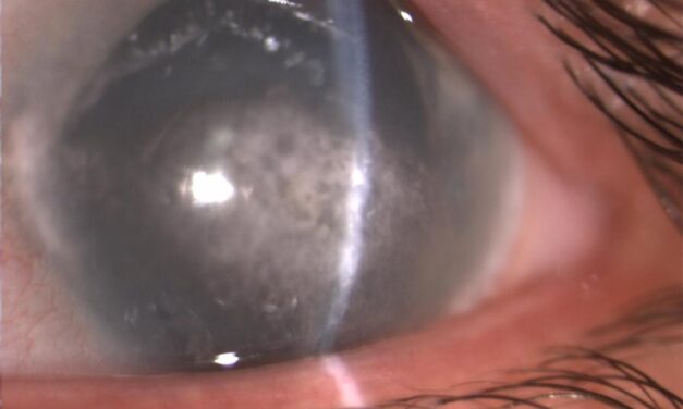Band Keratopathy: When Calcium Clouds the Cornea