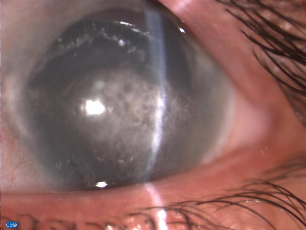Band keratopathy: horizontal, gray-white calcific band crossing the central cornea within the interpalpebral zone, with characteristic clear round holes within the band