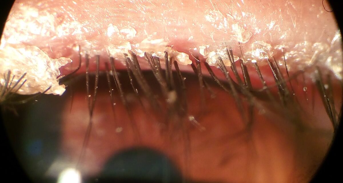 Blepharitis: Anterior, Posterior, and the Demodex Connection