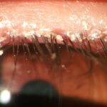 Blepharitis: slit-lamp close-up of the eyelid margin showing scaly, greasy debris and collarettes at the base of the eyelashes with mild lid margin erythema