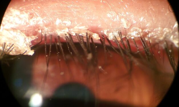 Blepharitis: Anterior, Posterior, and the Demodex Connection