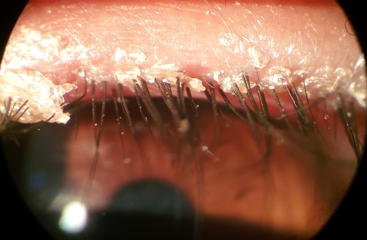 Blepharitis: slit-lamp close-up of the eyelid margin showing scaly, greasy debris and collarettes at the base of the eyelashes with mild lid margin erythema