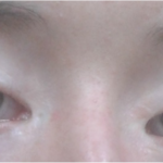 Blepharophimosis syndrome: bilaterally small horizontal palpebral fissures, ptosis, and epicanthus inversus skin folds at the medial canthi