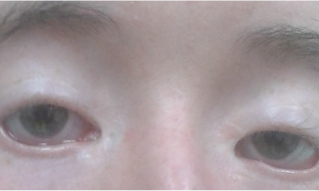 Blepharophimosis Syndrome: The Eyelid Finding That Predicts Ovarian Failure