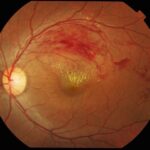Branch retinal vein occlusion: color fundus photograph showing sector flame-shaped and blot hemorrhages with retinal exudates along the distribution of the occluded superotemporal branch vein