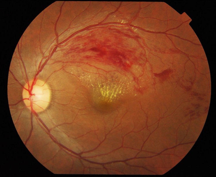Branch Retinal Vein Occlusion: When an Arteriovenous Crossing Threatens Central Vision