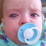 Primary congenital glaucoma: an infant with buphthalmos, showing an enlarged globe and a hazy, cloudy cornea on the affected side compared with the fellow eye