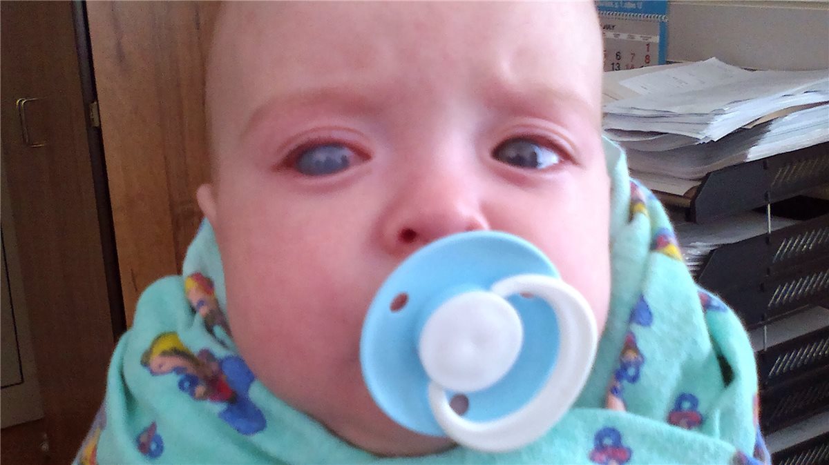 Primary congenital glaucoma: an infant with buphthalmos, showing an enlarged globe and a hazy, cloudy cornea on the affected side compared with the fellow eye