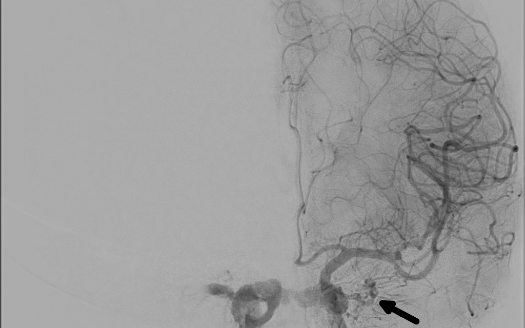 Carotid-Cavernous Fistula: When Proptosis Has a Pulse