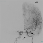 Carotid-cavernous fistula: a lateral cerebral angiogram following left internal carotid artery injection, with arrows indicating early filling of the cavernous sinus and draining veins through the fistula