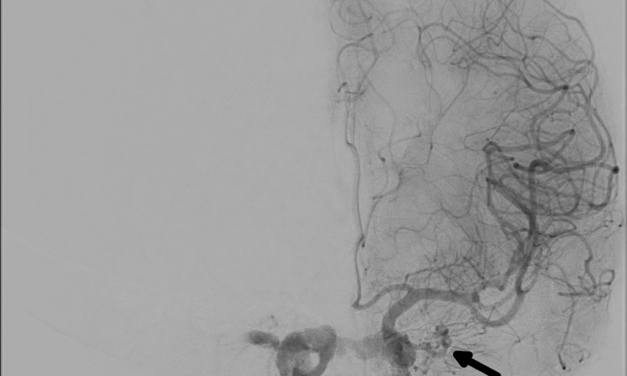 Carotid-Cavernous Fistula: When Proptosis Has a Pulse