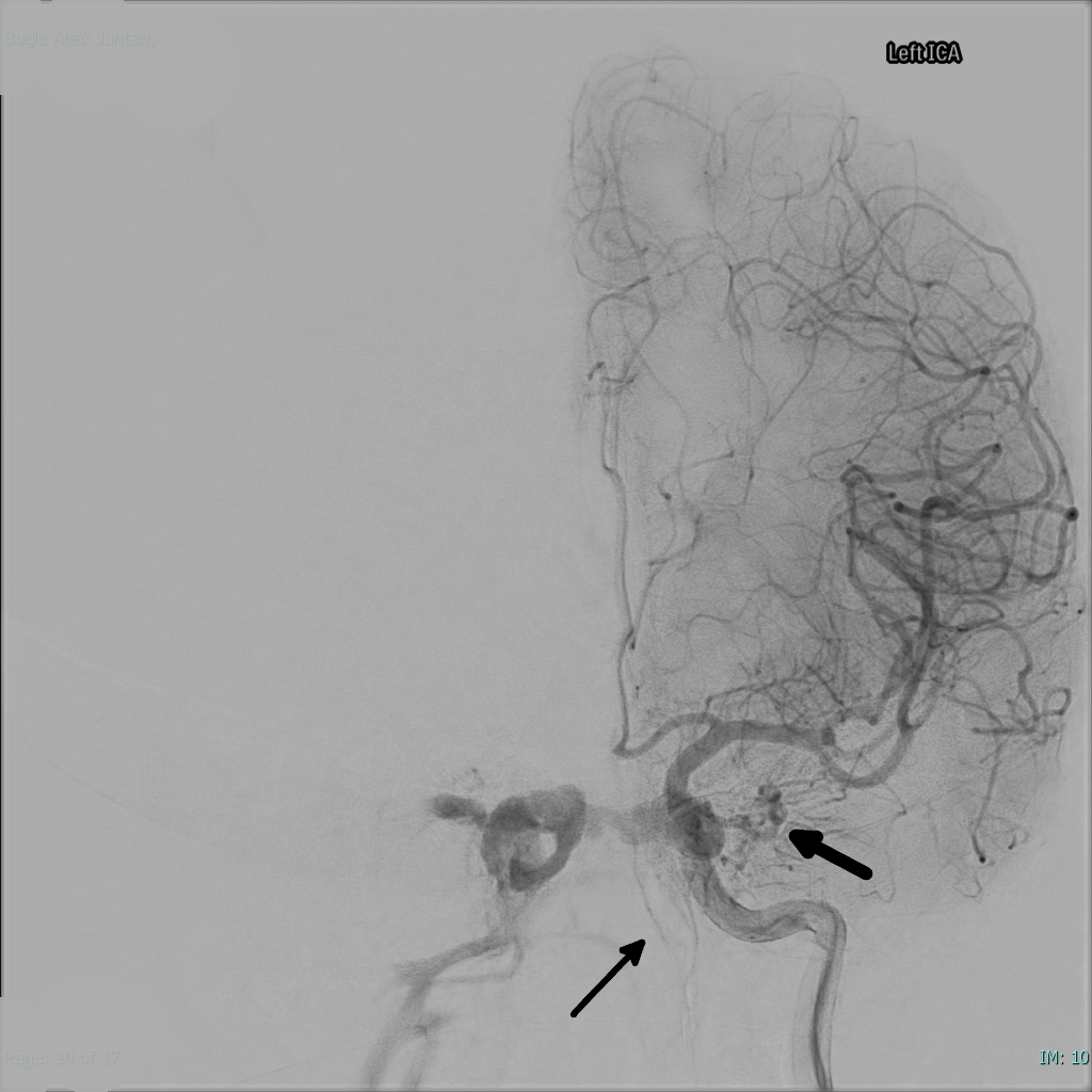 Carotid-cavernous fistula: a lateral cerebral angiogram following left internal carotid artery injection, with arrows indicating early filling of the cavernous sinus and draining veins through the fistula