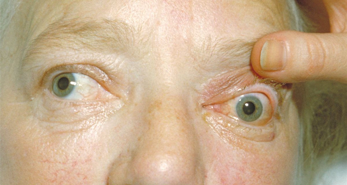 Cavernous Sinus Thrombosis: When Orbital Cellulitis Crosses the Midline