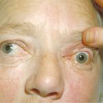 Cavernous sinus thrombosis: marked proptosis with periorbital swelling and discharge in a patient with orbital extension of a rhinocerebral fungal infection, a recognised cause of septic cavernous sinus thrombosis