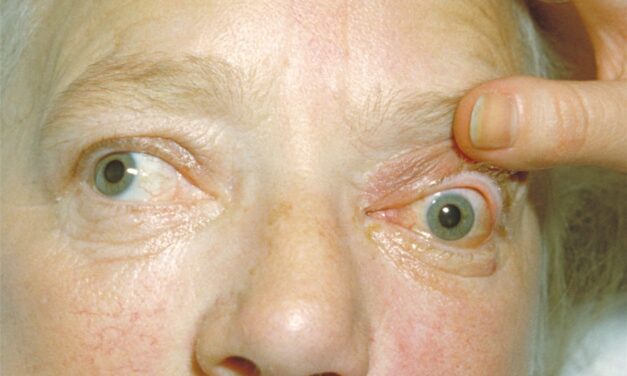 Cavernous Sinus Thrombosis: When Orbital Cellulitis Crosses the Midline
