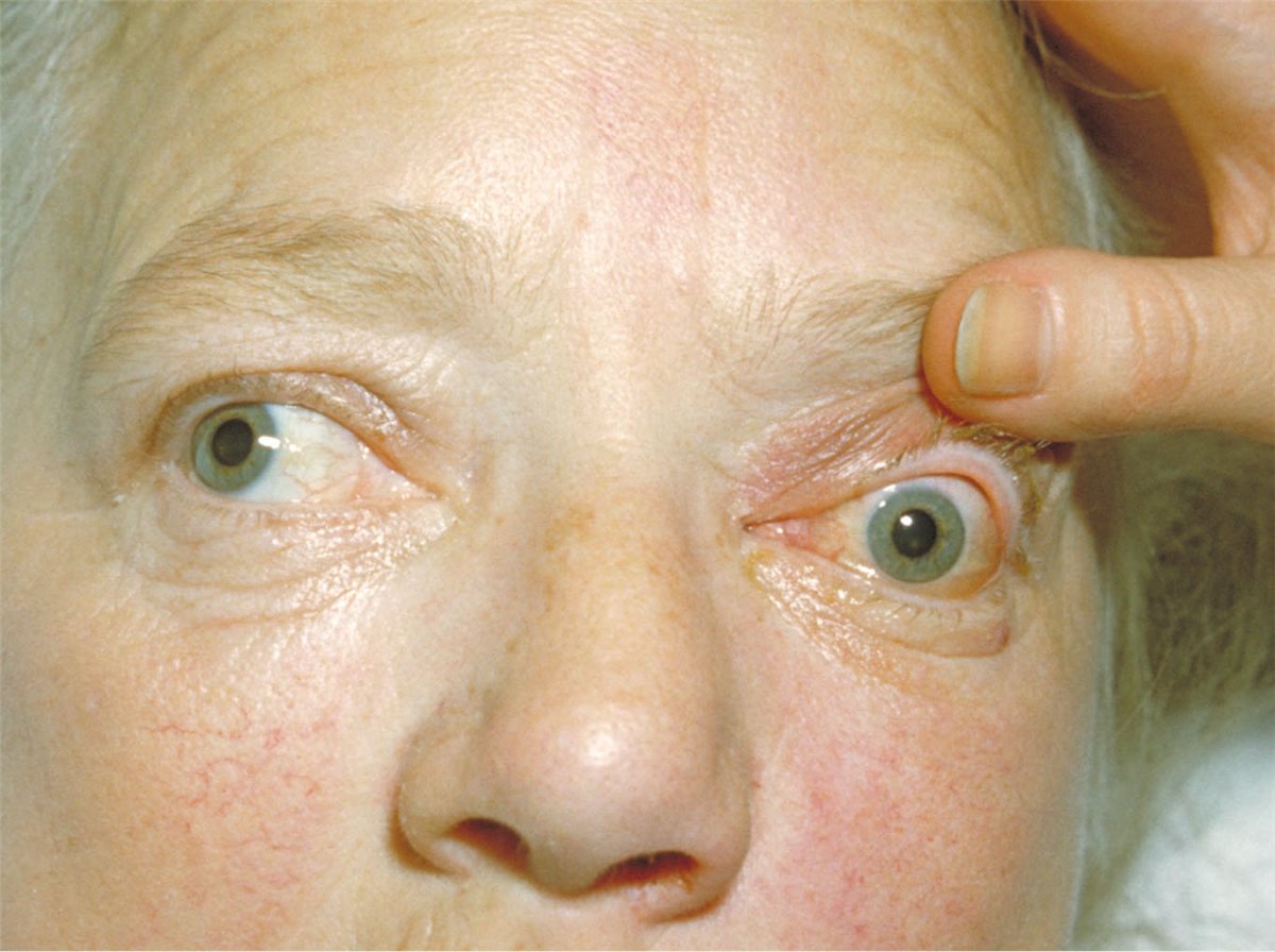 Cavernous sinus thrombosis: marked proptosis with periorbital swelling and discharge in a patient with orbital extension of a rhinocerebral fungal infection, a recognised cause of septic cavernous sinus thrombosis