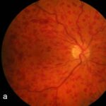 Central retinal vein occlusion: color fundus photograph showing diffuse flame-shaped and blot intraretinal hemorrhages scattered across all four quadrants with dilated, tortuous retinal veins
