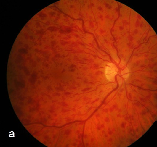 Central Retinal Vein Occlusion: Ischemic vs Non-Ischemic and Why It Matters