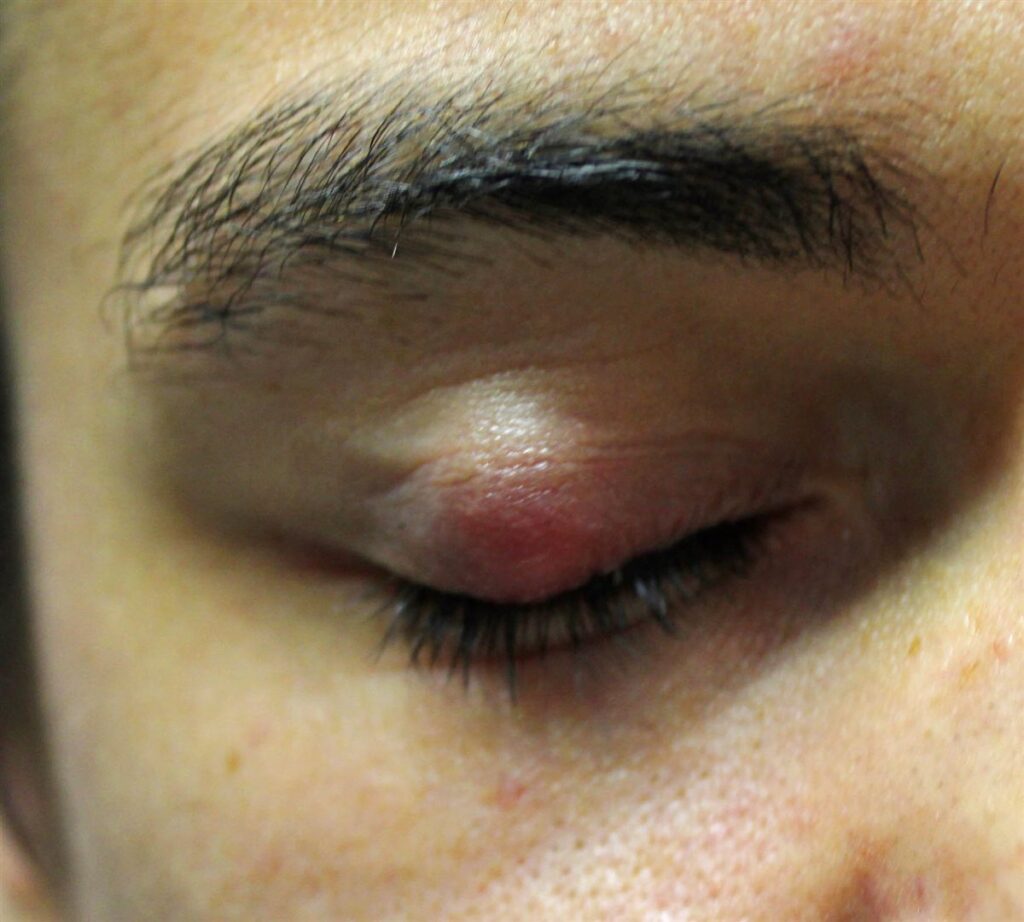 Chalazion: The Eyelid Lump That Isn’t an Infection