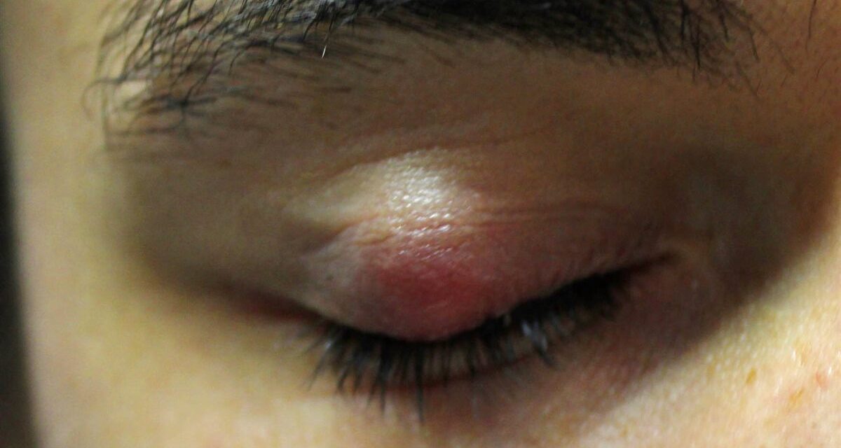 Chalazion: The Eyelid Lump That Isn’t an Infection