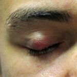 Chalazion: firm, well-circumscribed, non-tender nodule on the superior eyelid with mild overlying erythema, causing localized eyelid swelling