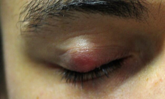 Chalazion: The Eyelid Lump That Isn’t an Infection