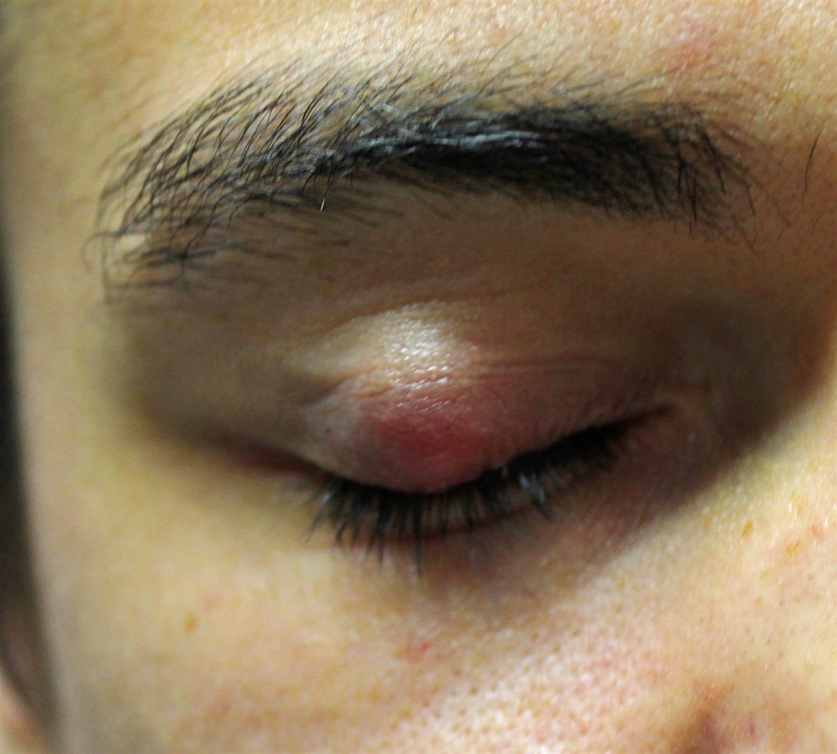 Chalazion: firm, well-circumscribed, non-tender nodule on the superior eyelid with mild overlying erythema, causing localized eyelid swelling