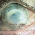 Chemical eye injury: dense corneal opacification and scarring with prominent corneal neovascularization following an alkali burn, consistent with limbal stem cell deficiency
