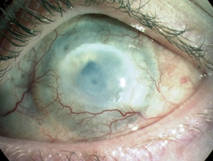 Chemical Eye Injury: Why Every Minute of Delay Matters