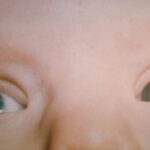 Congenital rubella syndrome: bilateral dense white cataracts in an infant, one of the classic triad findings alongside sensorineural hearing loss and congenital heart disease
