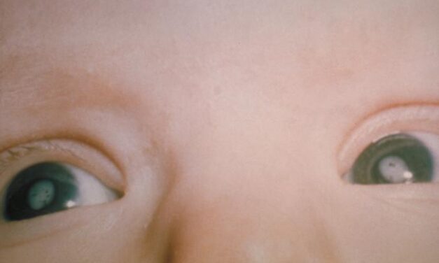 Congenital Rubella Syndrome: A Preventable Cause of Childhood Cataract
