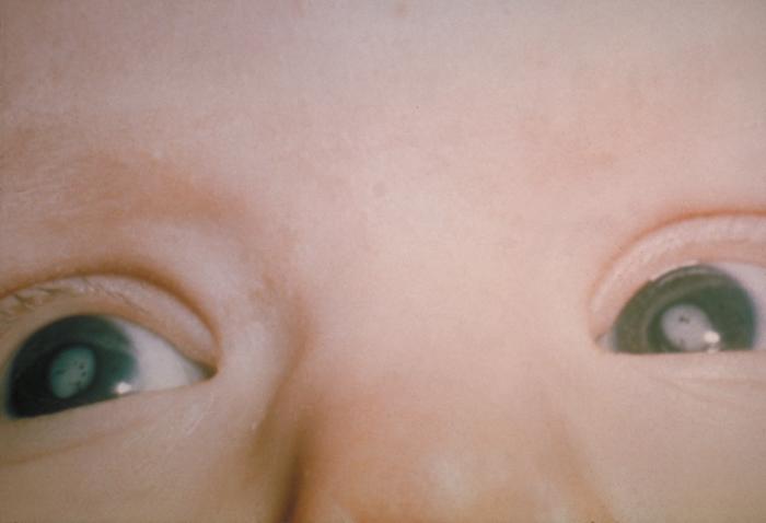 Congenital Rubella Syndrome: A Preventable Cause of Childhood Cataract