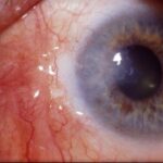 Conjunctival autograft: postoperative appearance following pterygium excision with conjunctival autograft, showing surface vascularity and a residual corneal opacity, illustrating a cosmetically imperfect but non-recurrent outcome