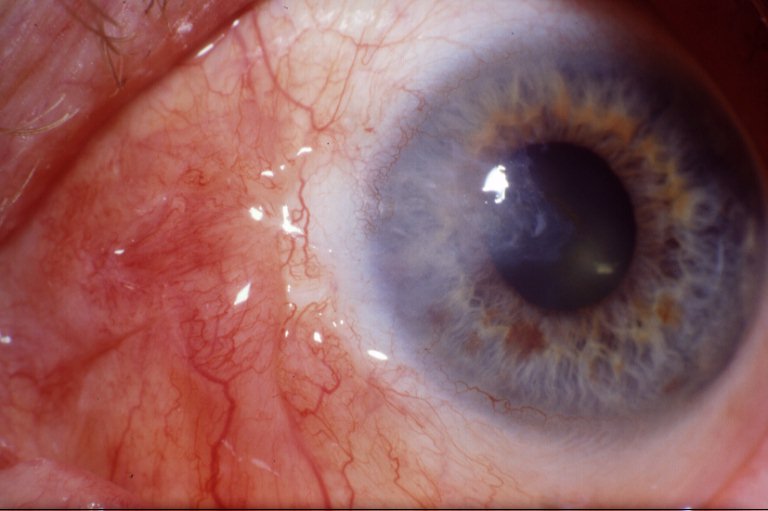 Conjunctival Autograft: The Step That Made Pterygium Surgery Reliable